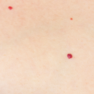 Cherry Angiomas