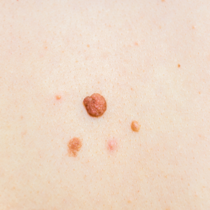 Skin Tags